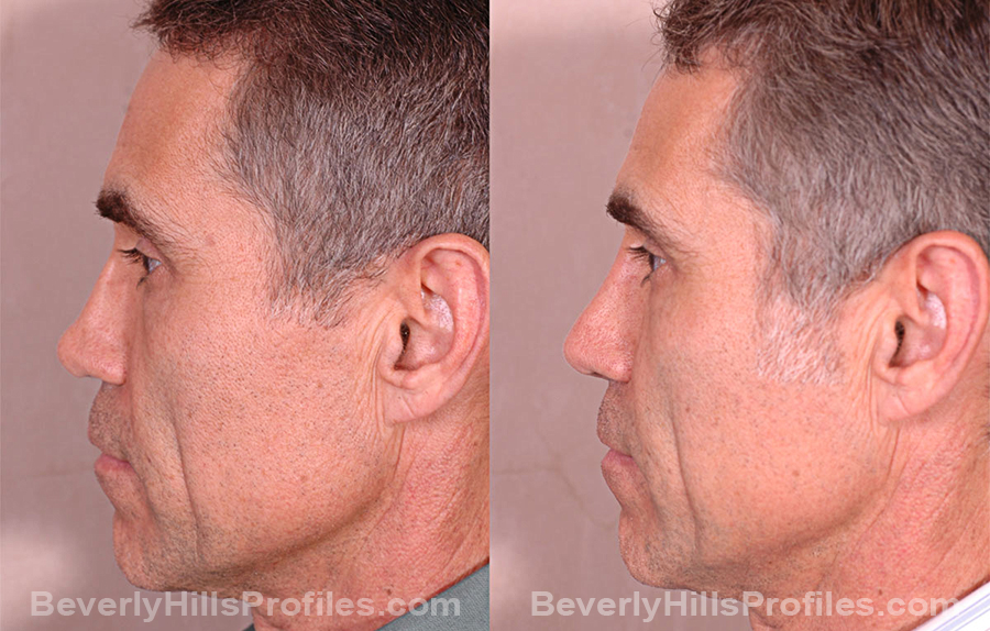 side view Male before and after Revision Rhinoplasty