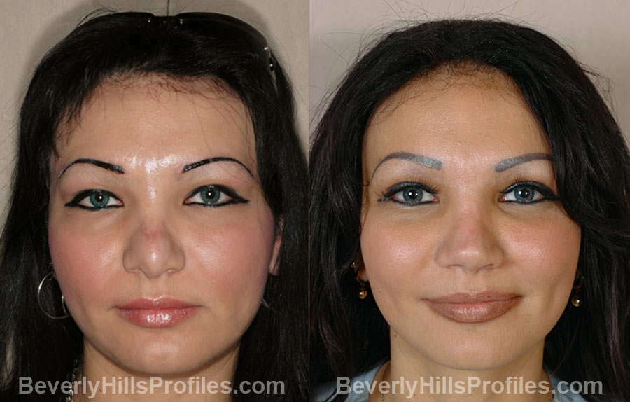 front view Female before and after Revision Rhinoplasty