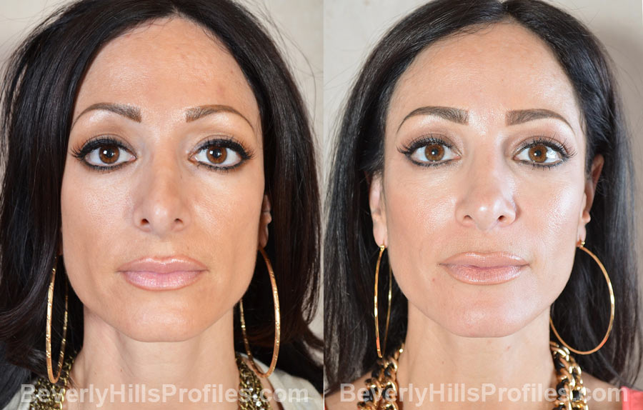 front view - Female patient before and after Revision Rhinoplasty