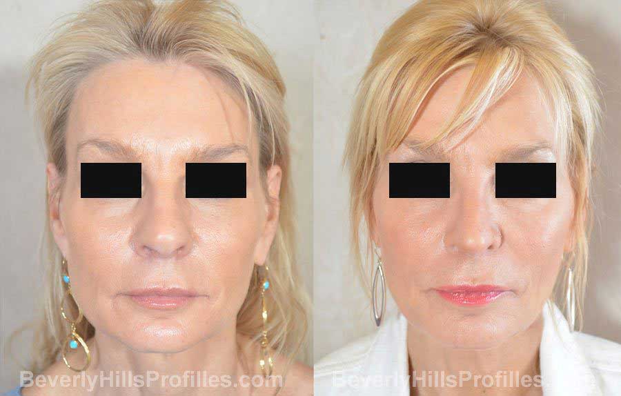 imgs Female before and after Nose Surgery front view