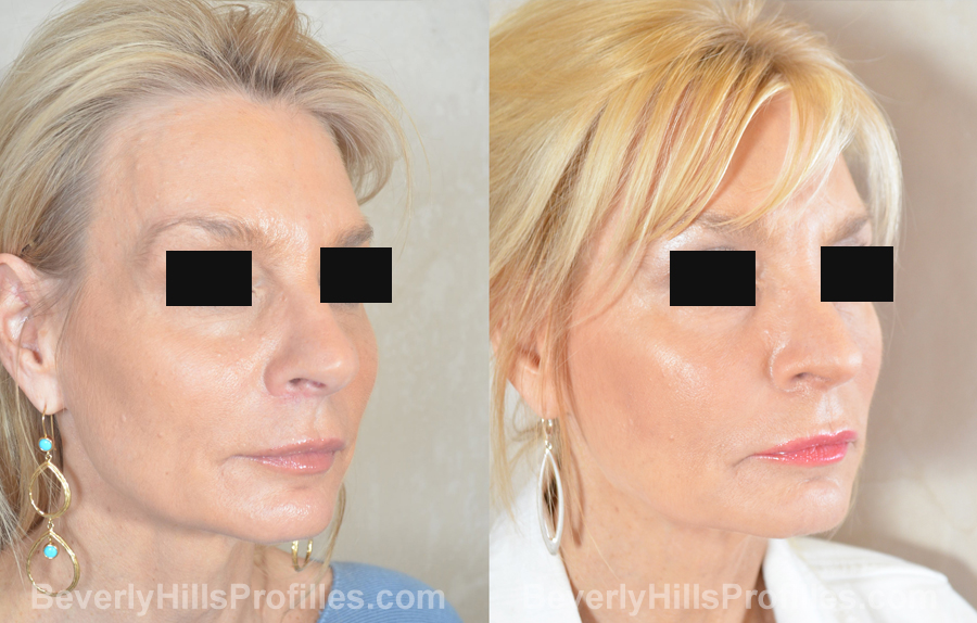imgs Female before and after Nose Surgery oblique view