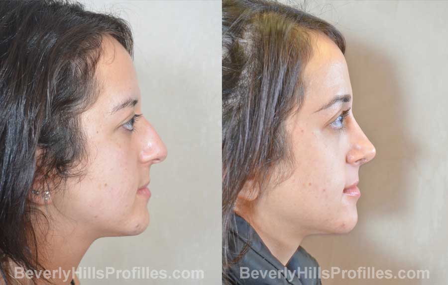 imgs Female before and after Nose Surgery, side view