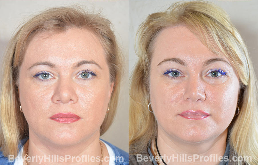 imgs female patient before and after Browlift Procedures