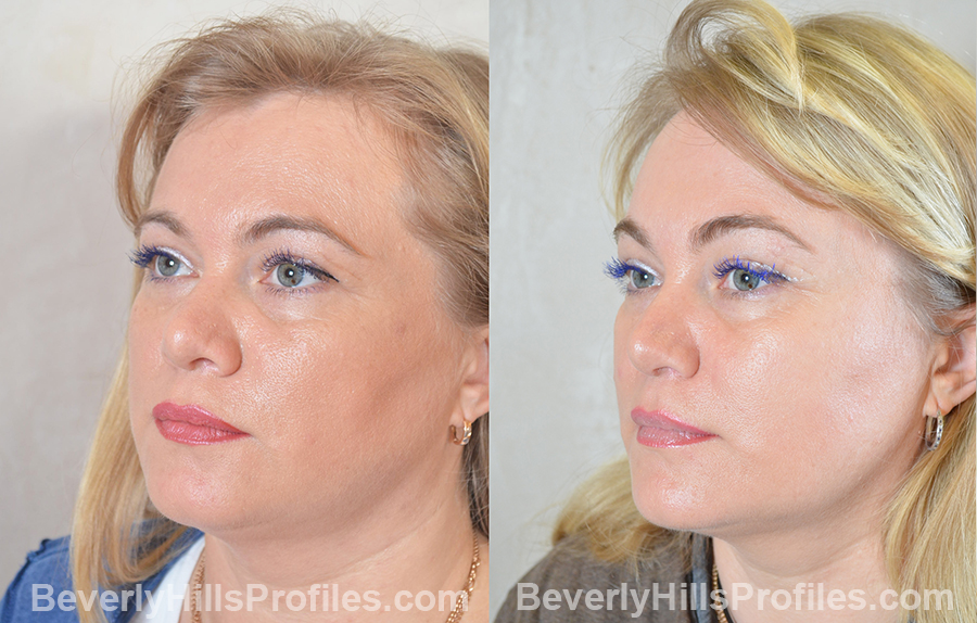 patient before and after Browlift Procedures