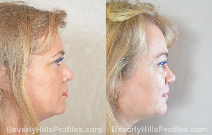 imgs female before and after Browlift Procedures