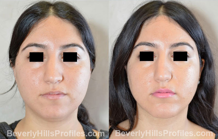 patient before and after Chin Implants - front view