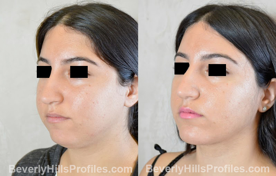 patient before and after Chin Implants - oblique view