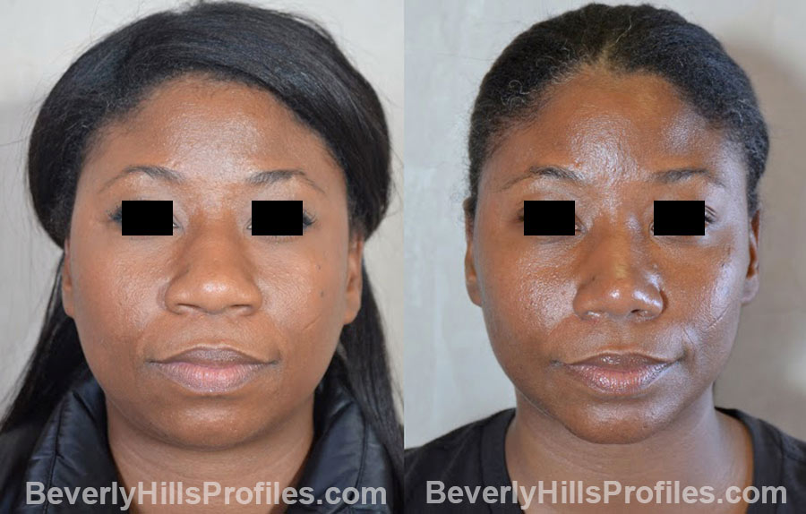 front view - Female patient before and after Chin Implants
