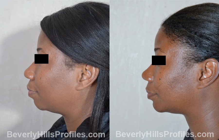 side view - Female before and after Chin Implants