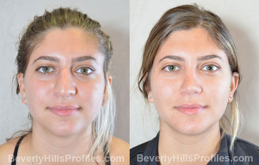 Female before and after Chin Implants - front view