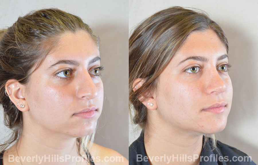 Female before and after Chin Implants - oblique view