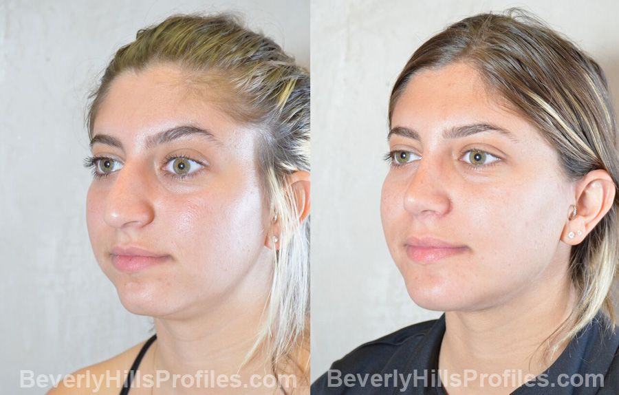 Female before and after Chin Implants, oblique view