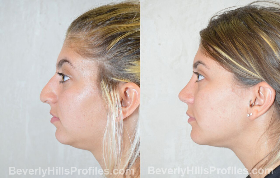 Female before and after Chin Implants - side view