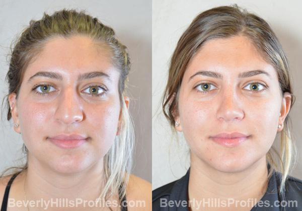 Female face, before and after Chin Implant treatment, front view, patient 9