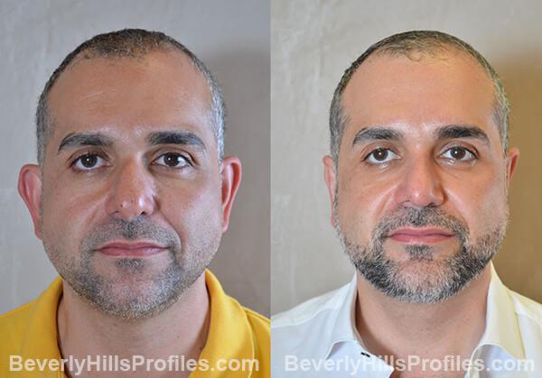 Male face, before and after Chin Implant treatment, front view, patient 10