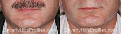Male face, before and after Chin Implant treatment, front view, patient 8