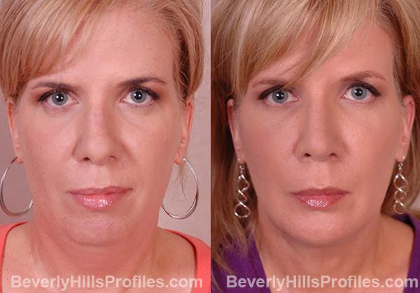 Female face, before and after Chin Implant treatment, front view, patient 2