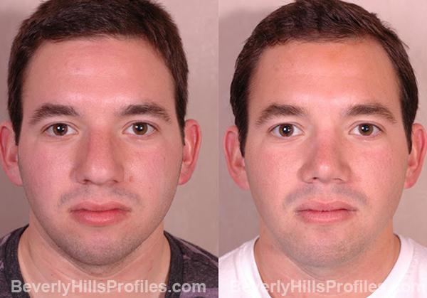 Male face, before and after Chin Implant treatment, front view, patient 3