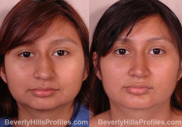 Female face, before and after Chin Implant treatment, front view, patient 4