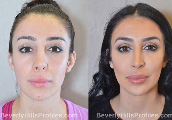 photos Female patient before and after Facial Fat Transfer, front view