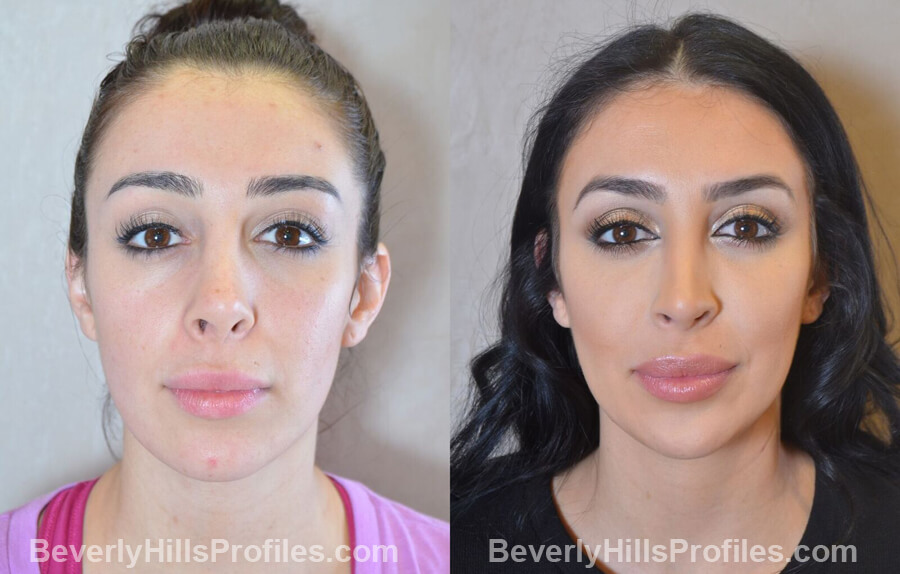 front view - Female patient before and after Facial Fat Transfer Procedures