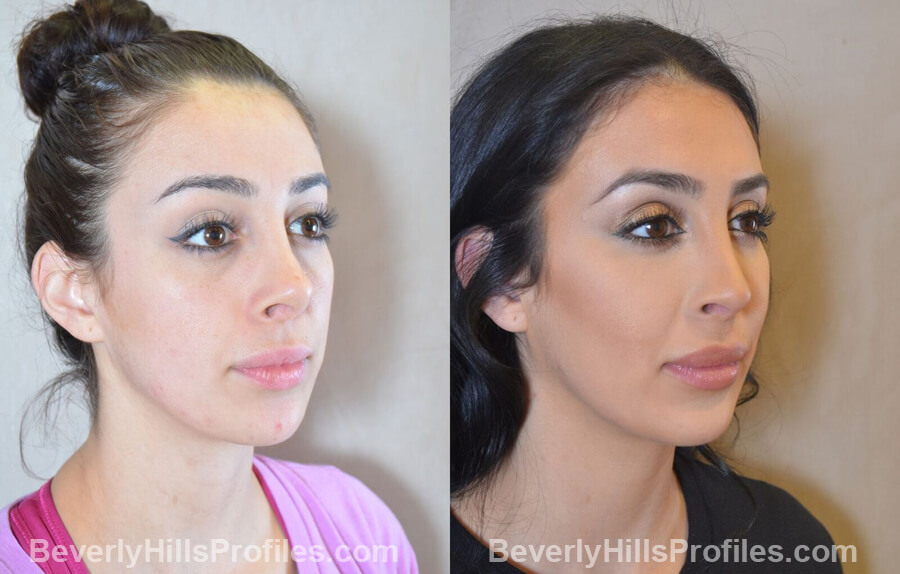 oblique view - Female patient before and after Facial Fat Transfer