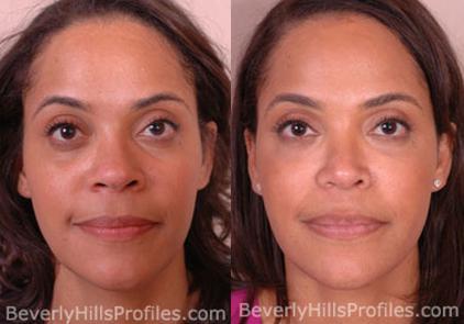 Female patient before and after Facial Fat Transfer, front view