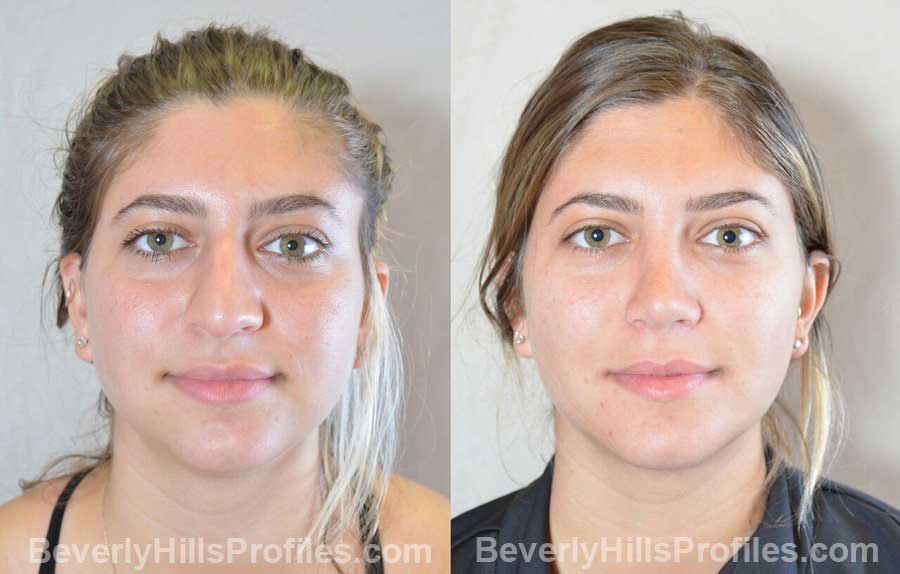 Female patient before and after Nose Surgery, front view