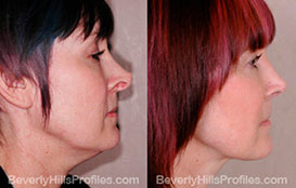 Woman's face, Before and After Photos. Neck Liposuction. Female - right side view