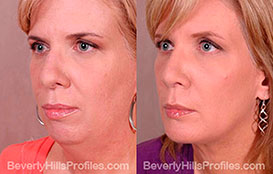 Woman's face, Before and After Photos. Neck Liposuction. Female - left side view, patient 2
