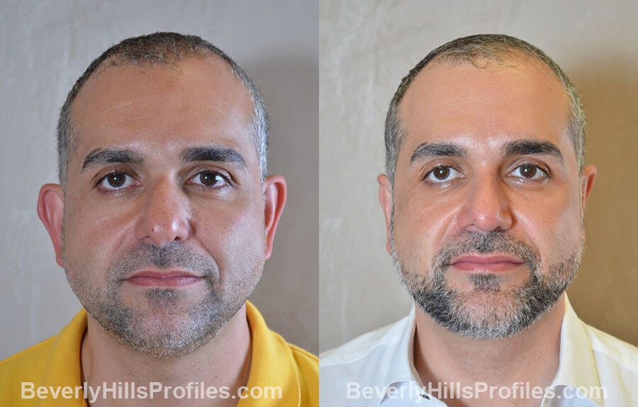 photos Male patient before and after Nose Surgery - front view