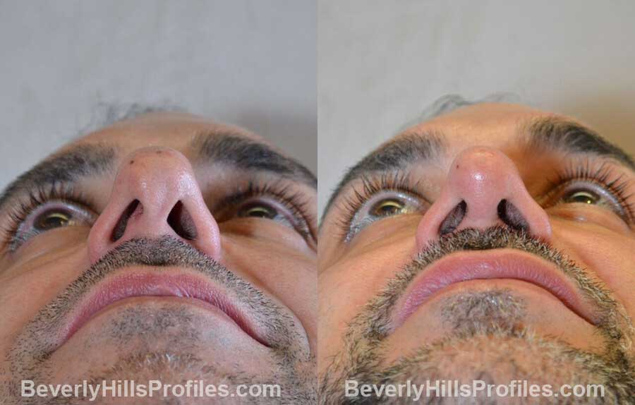 photos Male patient before and after Nose Surgery - underside view