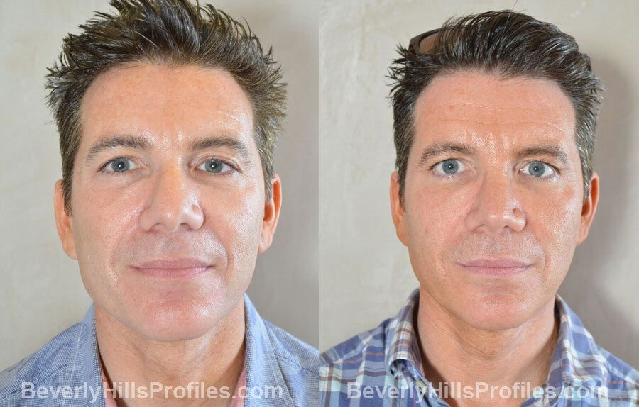 photos Male patient before and after Nose Surgery Procedures - front view