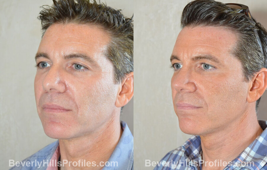 photos Male patient before and after Nose Surgery Procedures - left oblique view