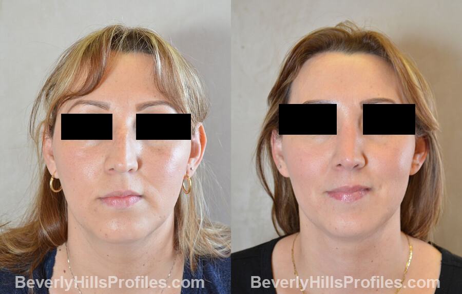 photos female patient before and after Necklift - front view