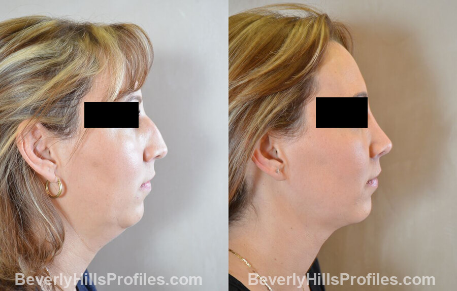 photos female patient before and after Necklift - right side view