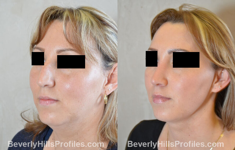 photos female patient before and after Necklift - left oblique view