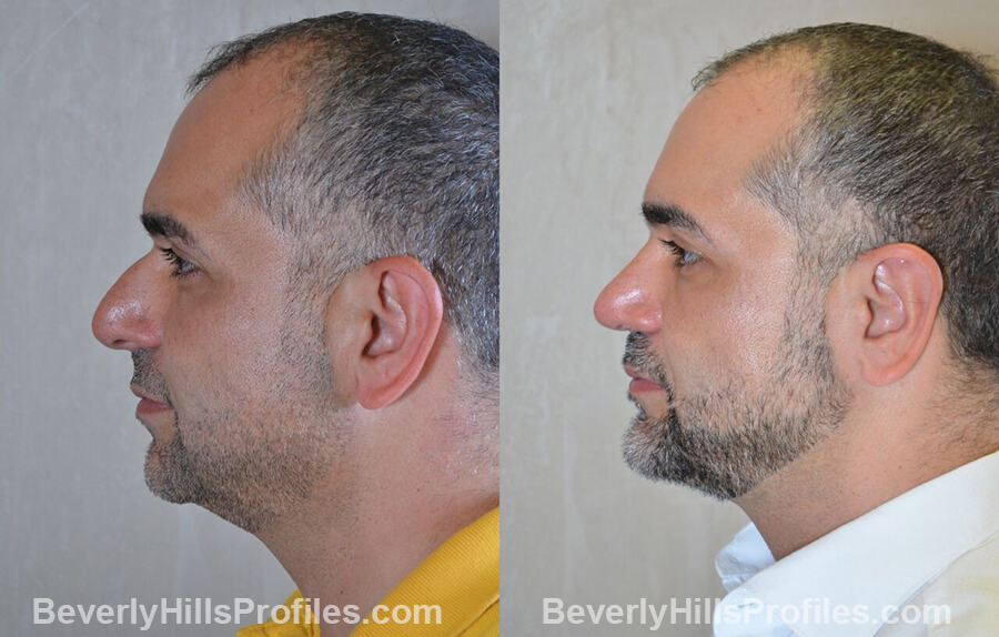 photos male patient before and after Necklift - left side view