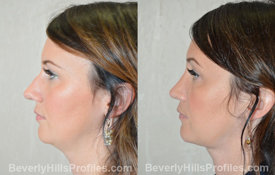 left side view before and after Necklift Procedures