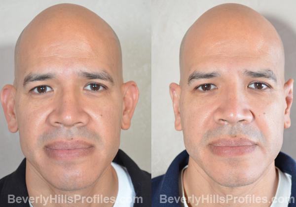 male patient before and after Otoplasty Procedures