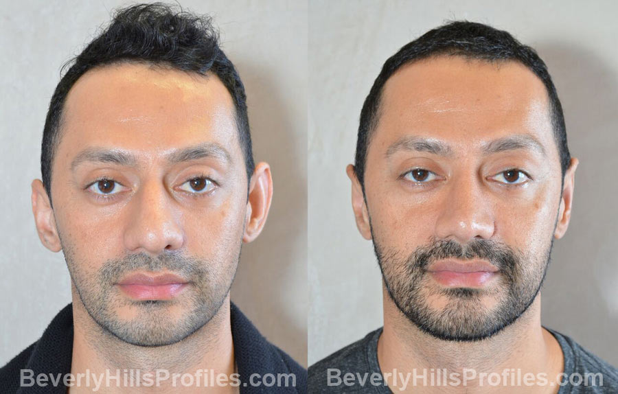 images male patient before and after Otoplasty Procedures - front view