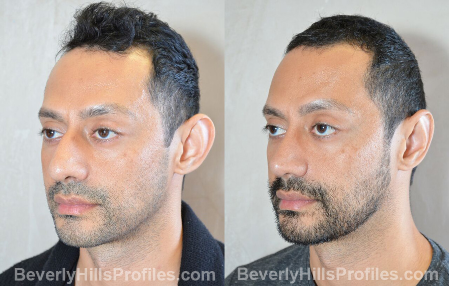 images male patient before and after Otoplasty Procedures - oblique view
