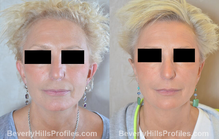 female patient before and after Otoplasty Procedures - front view