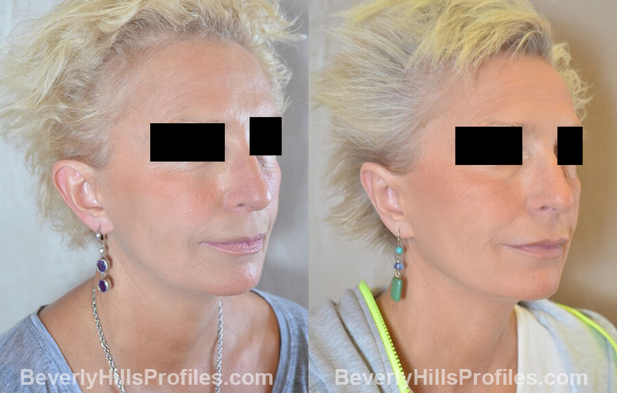 female patient before and after Otoplasty Procedures - oblique view