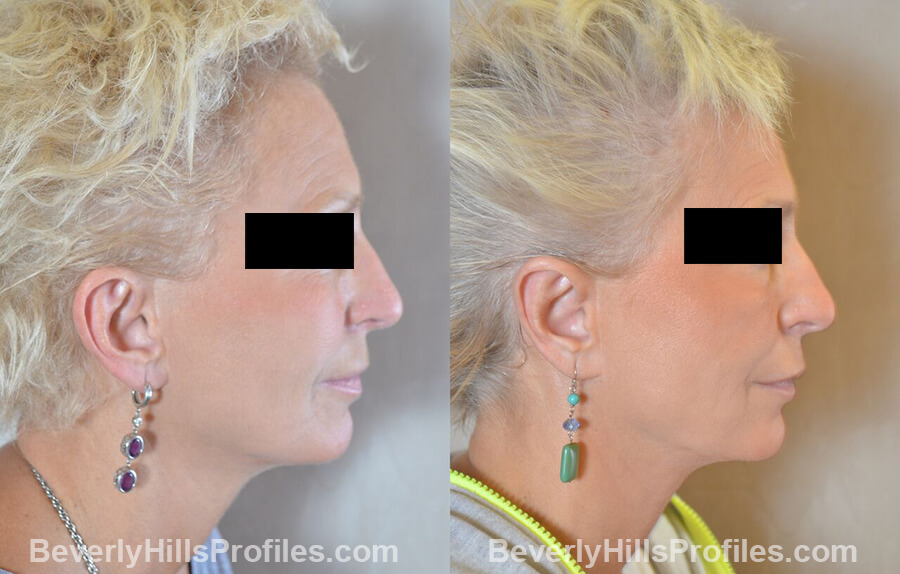 female patient before and after Otoplasty Procedures - right side view