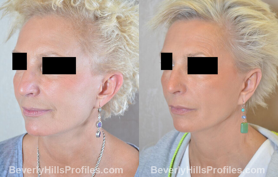 female patient before and after Otoplasty Procedures - left oblique view