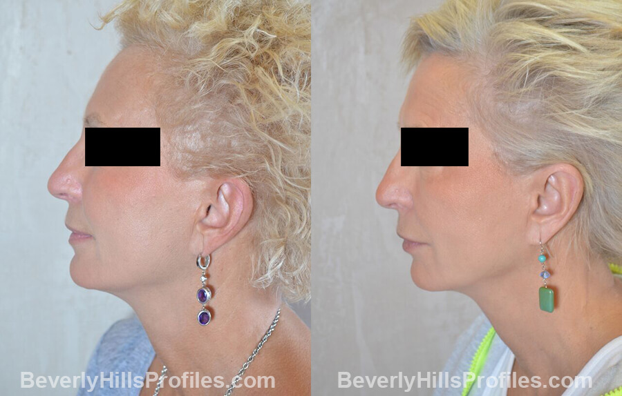 female patient before and after Otoplasty Procedures - left side view