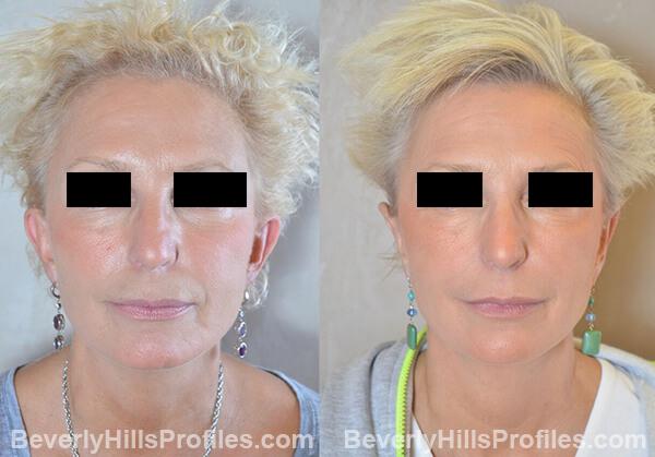 female patient before and after Otoplasty Procedures