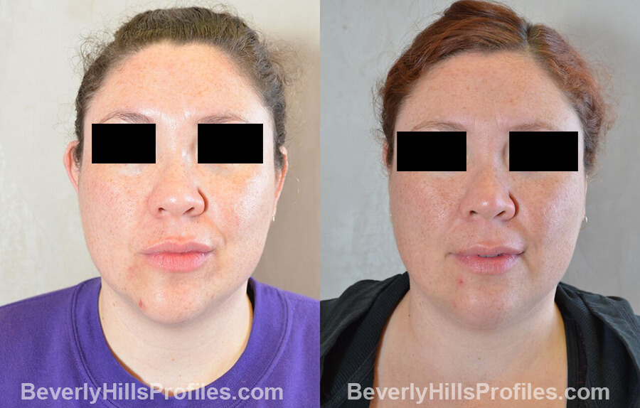 photos female patient before and after Otoplasty Procedures - front view