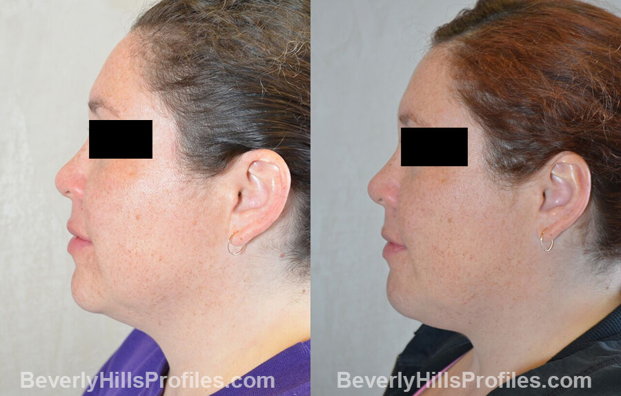 photos female patient before and after Otoplasty Procedures - left side view
